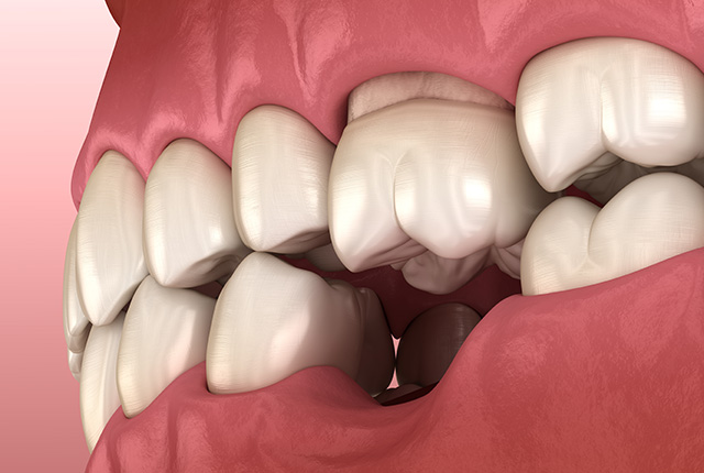 歯が抜けている画像イメージ